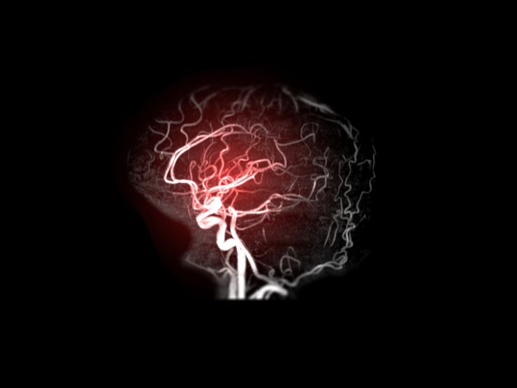 Ischemia cerebrale: i sintomi da riconoscere